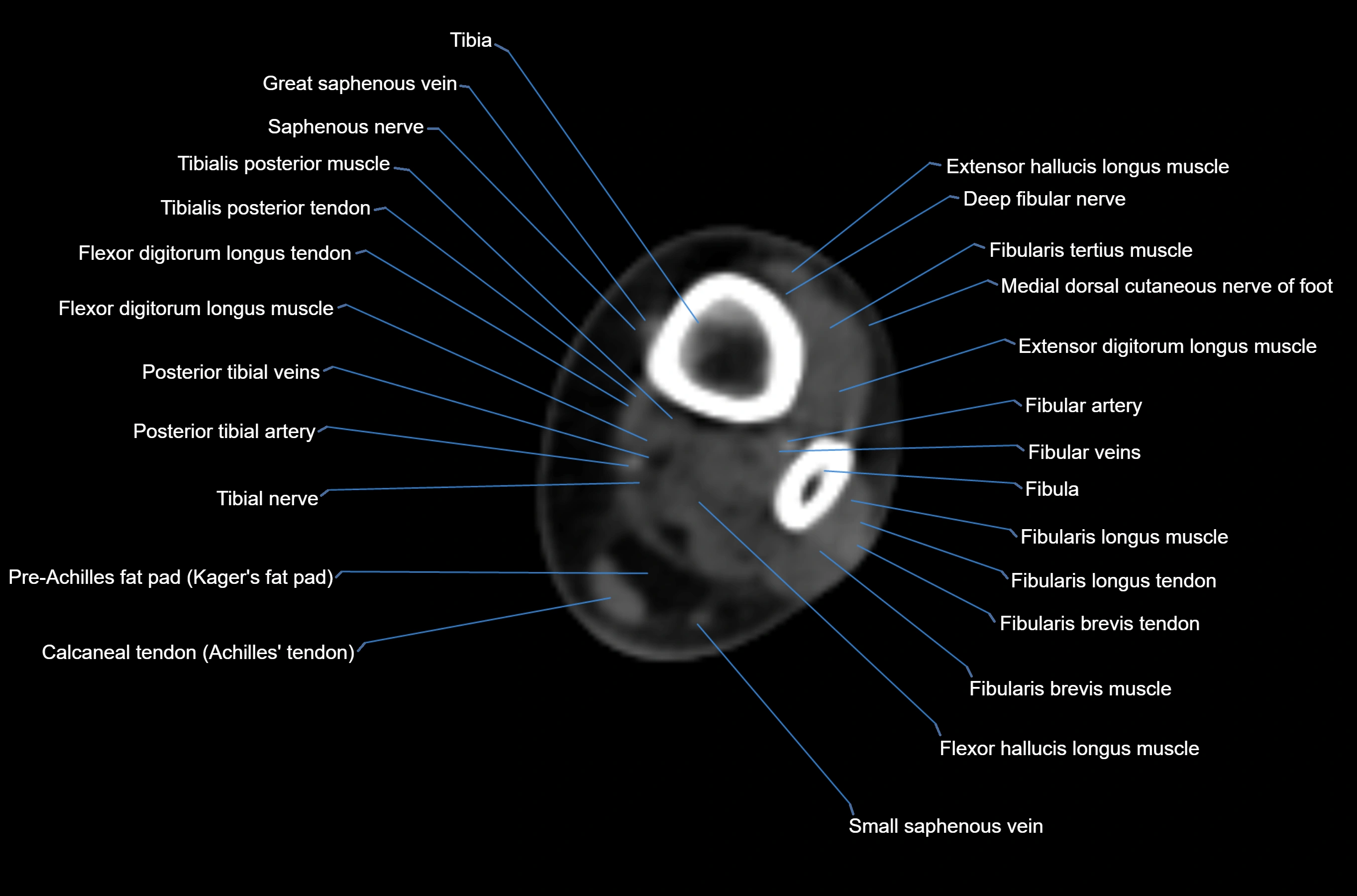 CT Ankle axial cross sectional anatomy labelled image -00011.webp